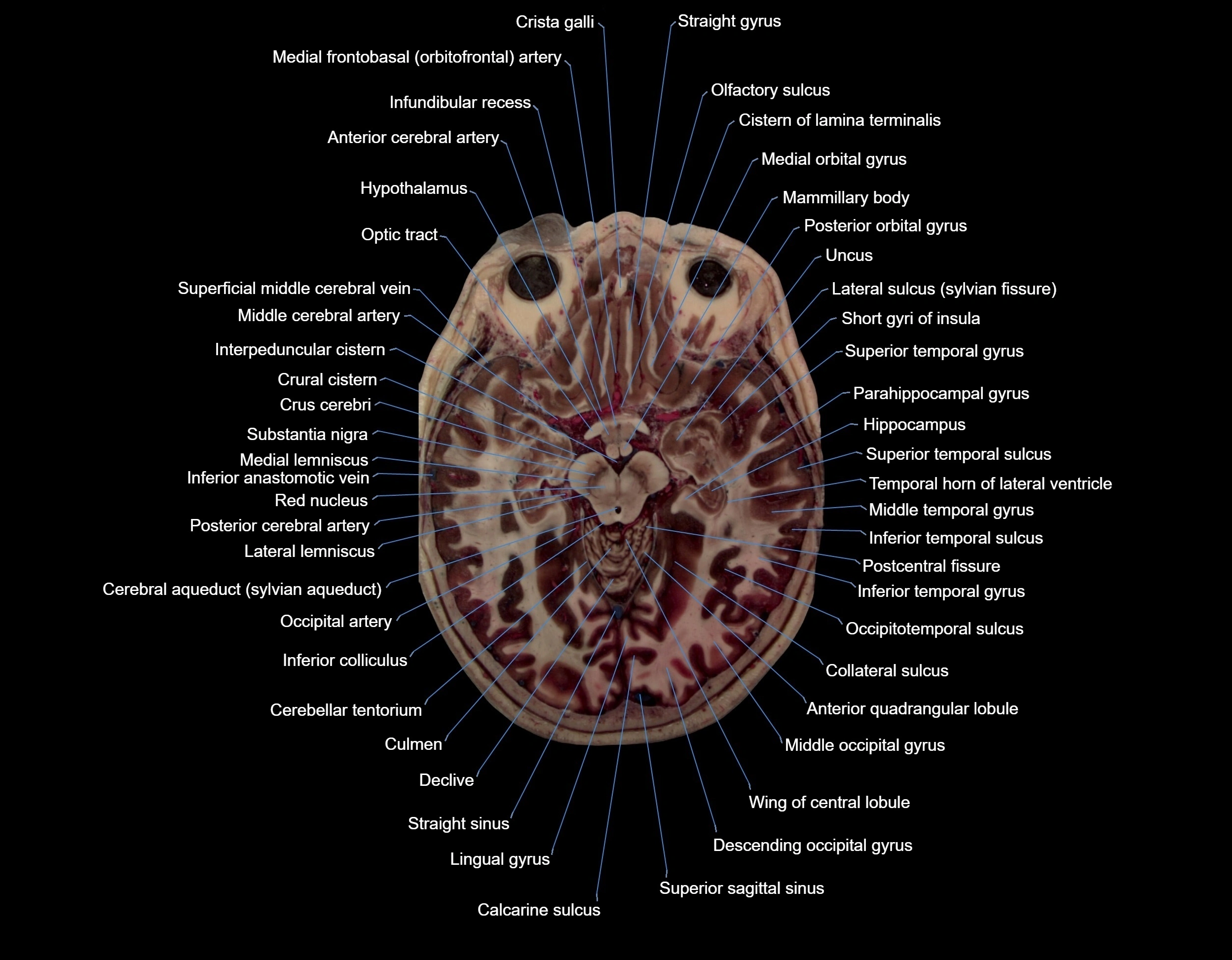 MRI Brain axial cross sectional radiology anatomy 3T image  -img-000035.webp